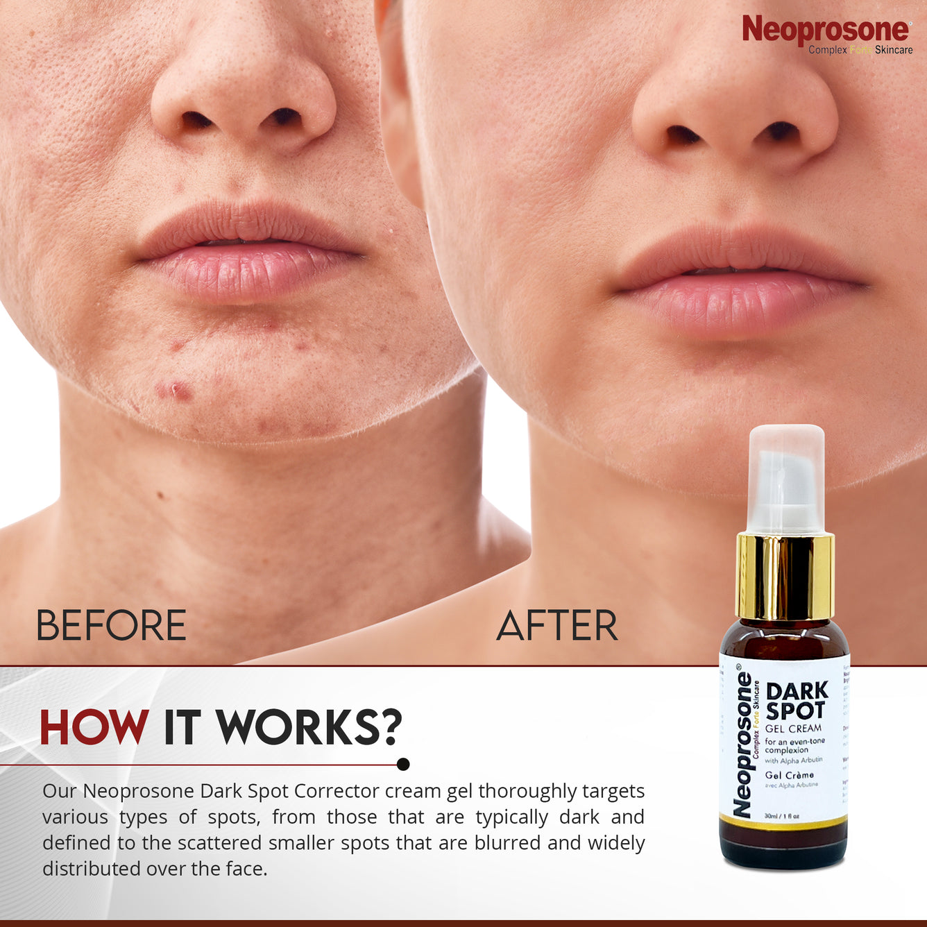 Gel-crème anti-taches US Neoprosone 30 ml