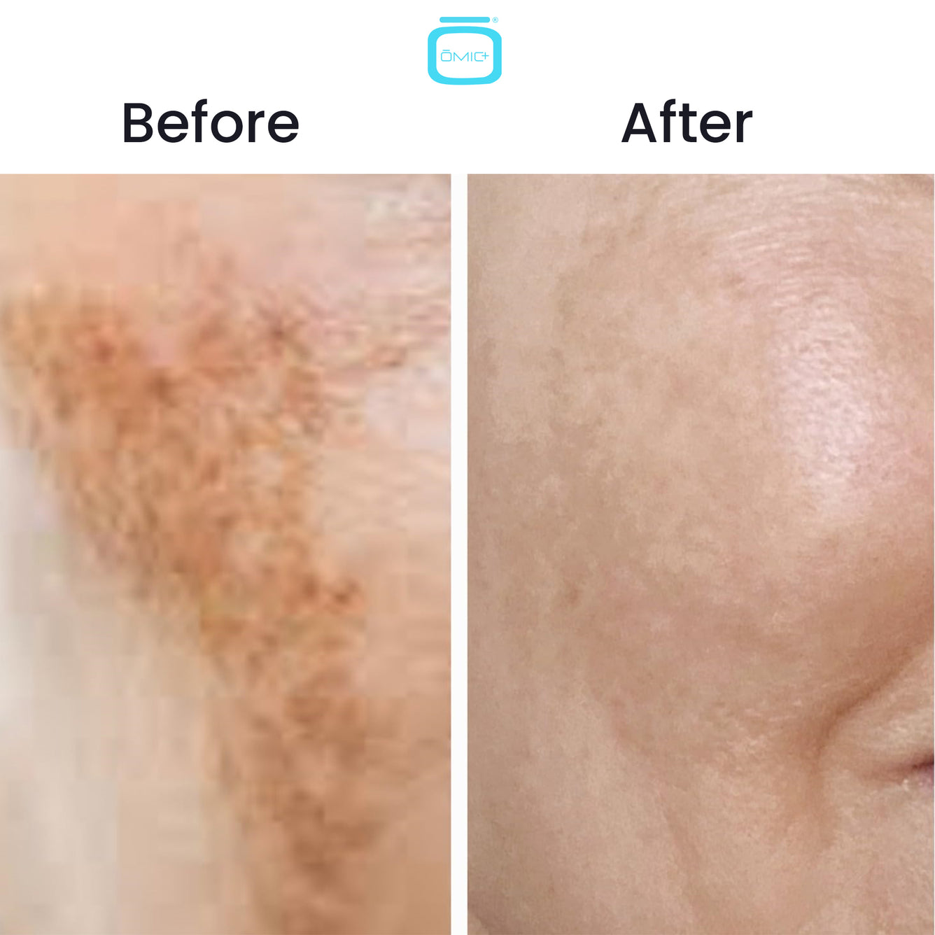 Omic+ 10% Tranexamic Acid Cream 30ml
